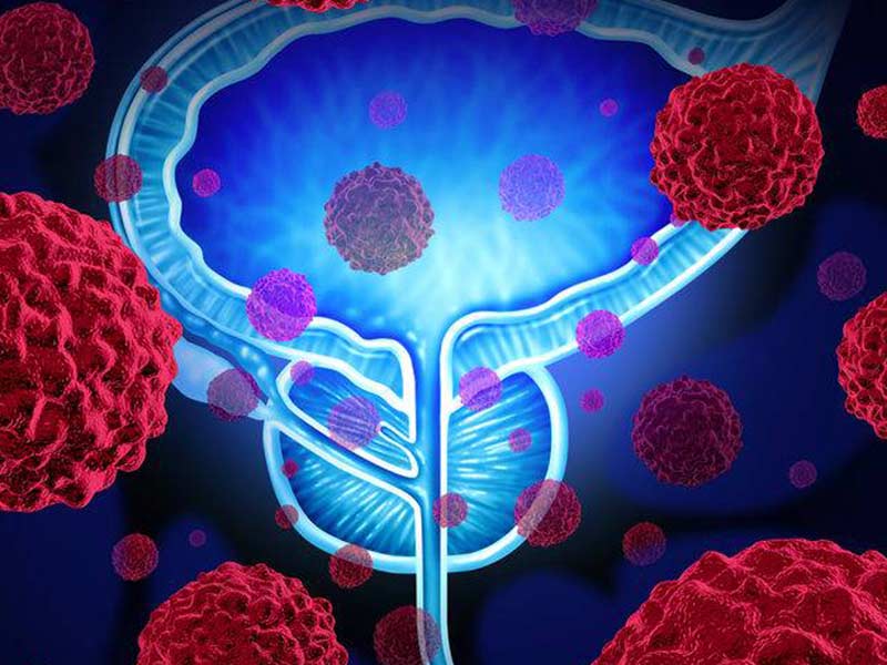 tumore prostata risonanza multiparametrica tumore prostata risonanza multiparametrica