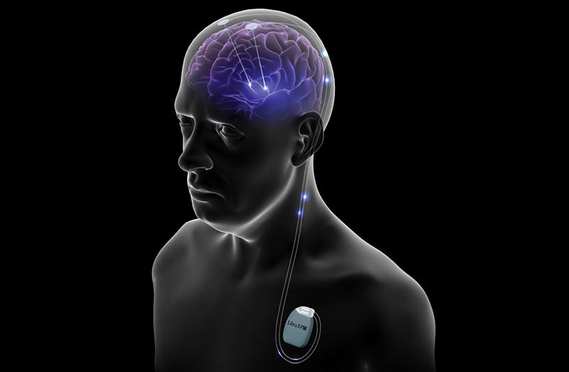Morbo di Parkinson, la Dbs non è una panacea Morbo di Parkinson, la Dbs non è una panacea
